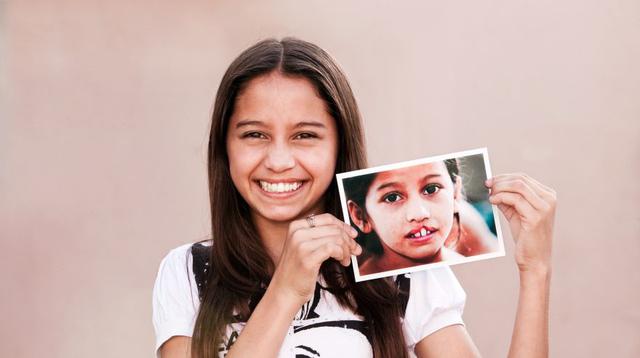 A la fecha, Operación Sonrisa ha beneficiado a 5,793 personas con labio fisurado y paladar hendido. (Foto: Difusión)