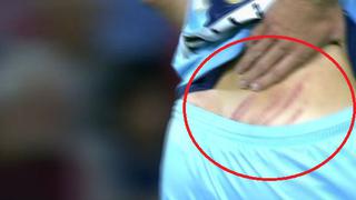 España: así quedó la espalda de jugador tras fortuito planchazo