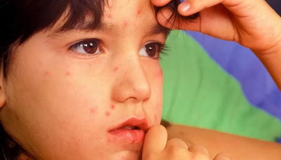 La viruela fue erradicada en el mundo hace 40 años. (Getty Images).