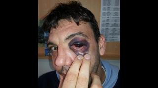 Básquet: sufrió golpazo en el ojo y lo muestra en Twitter