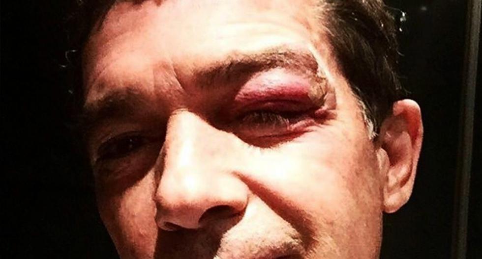 Antonio Banderas sufre accidente en el rostro. (Foto: Instagram)