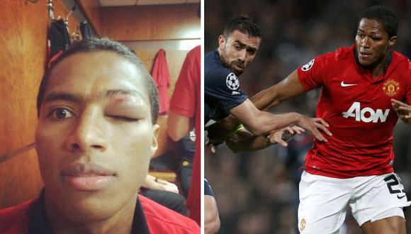 Valencia del Manchester United hizo un 'selfie' de su hematoma
