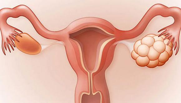El Síndrome de Ovario Poliquístico es la principal alteración hormonal en las mujeres.