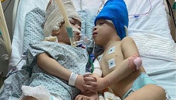 La cirugía de los pequeños Bernardo y Arthur Lima, de 3 años, tuvo lugar en Río de Janeiro.