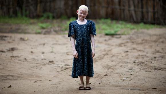 Por qué a los albinos de Tanzania los "matan como a animales"
