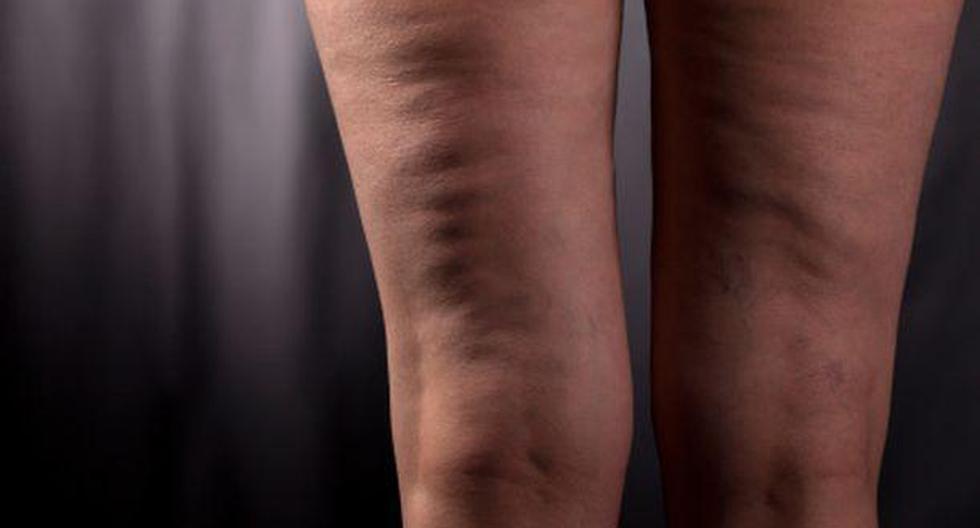 Combate la flacidez de las piernas con estas 6 maneras. (Foto: Getty Images)