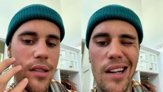 Justin Bieber reveló que tiene la mitad del rostro paralizado: “No puedo sonreír”