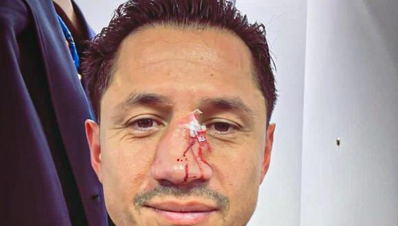 Gianluca Lapadula y el doloroso estado de su nariz tras recibir patada en la cara | Foto: Gianluca Lapadula