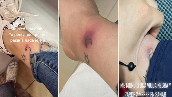 Una joven sufrió una picadura de una viuda negra y así quedarse su pierna tras infectarse | FOTO: @000012022096av / TikTok