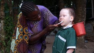 Tanzania: Los albinos buscan seguridad en la isla de Ukerewe