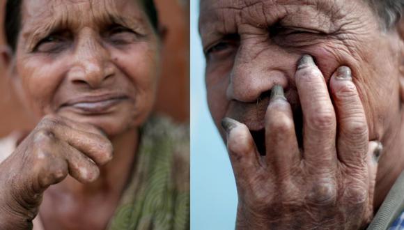 La lepra dejará de ser una razón para el divorcio en la India. (EFE)