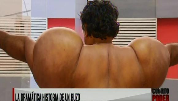 El nitrógeno se alojó en especie de bolsas y se adhirieron a los músculos. Esto ha originado que el cuerpo de Ramos Martínez se deforme y aumente en 30 kilos su peso.