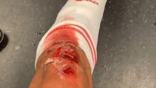 Sudor y sangre: Edson Álvarez y su espantosa herida tras triunfo del Ajax | FOTO 