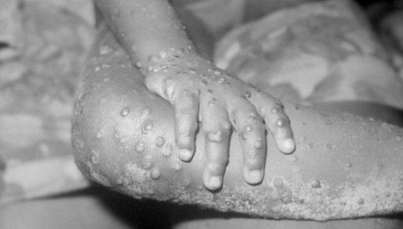 La enfermedad producía una característica erupción en la piel cuyas manchas se convertían en pústulas. (GETTY)