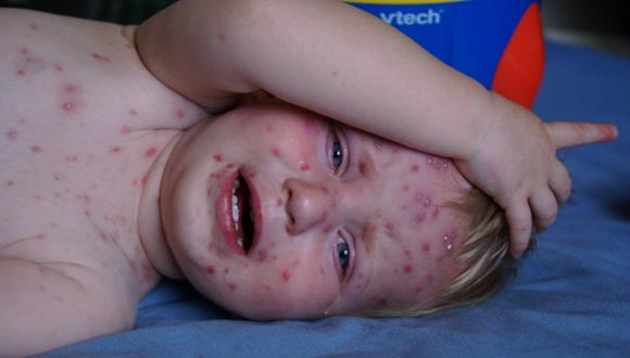 El virus que causa la varicela es el virus varicela zoster. (Foto: Phyllis Buchanan en Flickr / Bajo licencia Creative Commons)