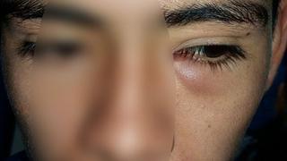 Doctores usan hojas de albahaca para salvar ojo a adolescente