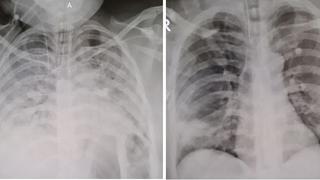 Impacto del coronavirus: ¿Cómo se ven los pulmones de un paciente vacunado y otro sin vacunar?