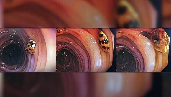 Descubre que una mariquita vive en su intestino tras una colonoscopia. (Foto: ACG Case Reports Journal)
