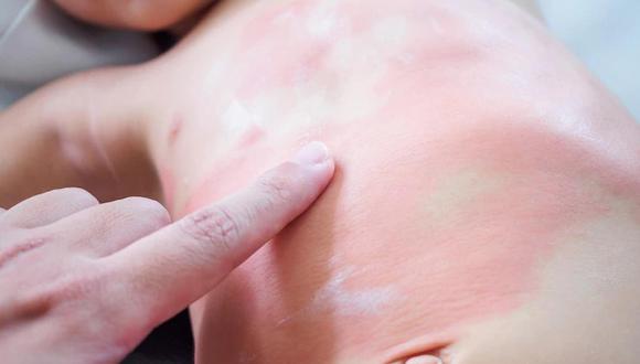 Uno de los desencadenantes de la dermatitis atópica es la exposición del niño a espacios con ácaros y humedad. (Foto: Freepik)
