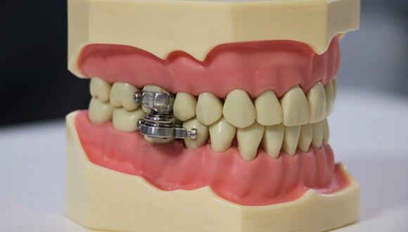 El polémico dispositivo para adelgazar que evita que la boca se abra más de 2 milímetros. (Foto: @otago)