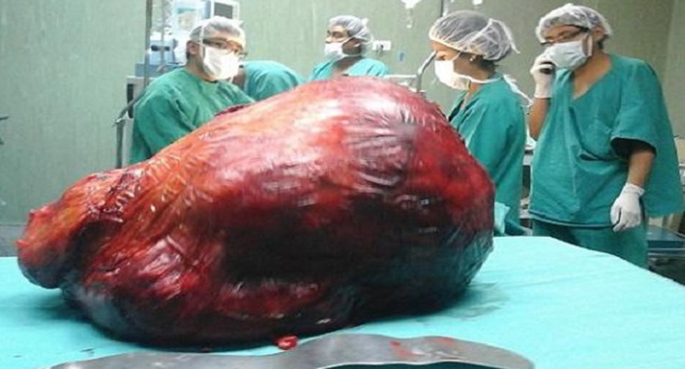 Un tumor gigante, de casi 20 kilos, fue extraído por