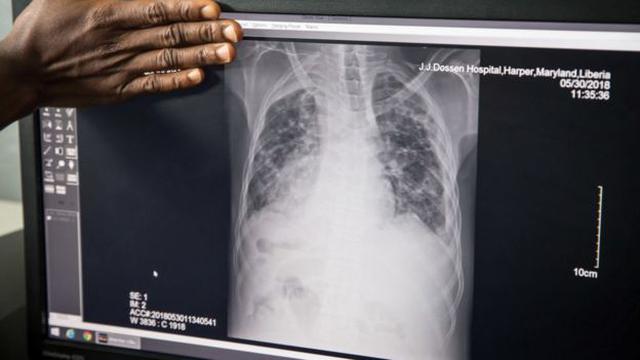 La tuberculosis es la enfermedad infecciosa que más muertes produce en el mundo.