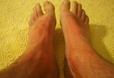 ¿Síndrome de los pies calientes? 6 tratamientos caseros para combatirlo