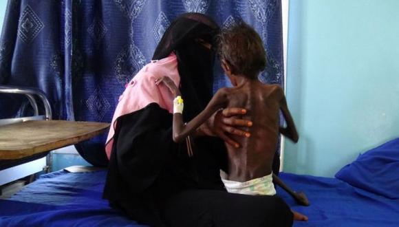 Miles de niños sufren de desnutrición severa a causa de la guerra. Foto: AFP