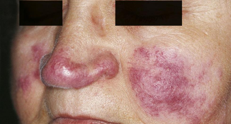 Lesiones en el rostro causadas por el lupus. (Foto: Wikimedia)