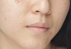 ¿Quieres evitar las manchas en el rostro? Sigue estos consejos 