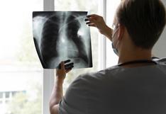 Tabaquismo: cómo la neumología intervencionista brinda nuevas posibilidades en la salud de los pulmones