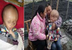 China: Padres piden ayuda para curar a su hijo con hidrocefalia
