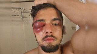 Así quedó el rostro de Anthony Yigit tras perder una pelea de box por un título mundial