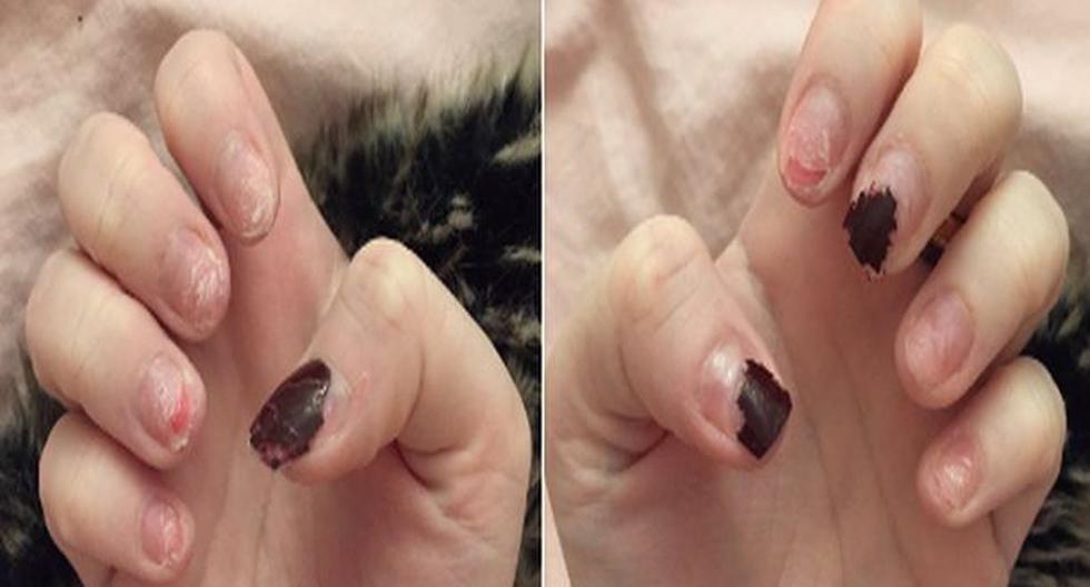 Detalle 39+ imagen consecuencias de las uñas acrilicas