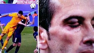 Godín: así le quedó el ojo tras agresión de Luis Suárez [VIDEO]