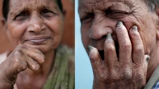 La lepra dejará de ser una razón para el divorcio en la India