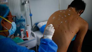Viruela del mono en Perú: ¿quiénes serán los primeros en recibir la vacuna contra la enfermedad?