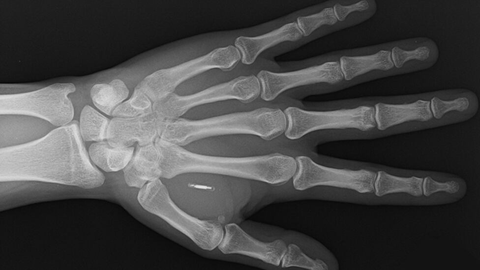 The Walletmor chip is placed in the person's hand after a local anesthetic.