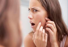 4 mitos del acné que debes desterrar 