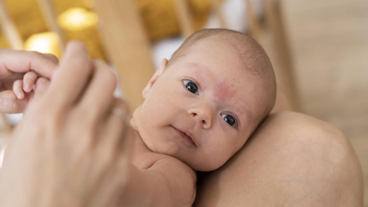 Qué es la costra láctea del bebé?