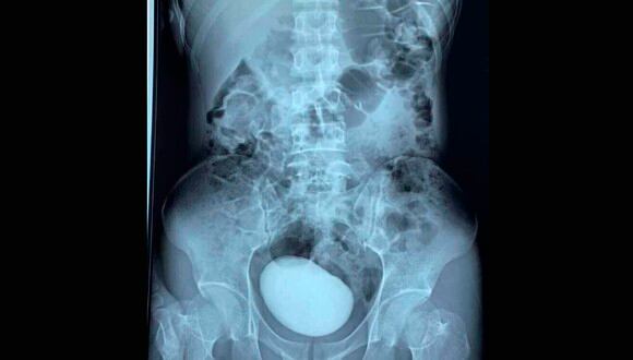 Tras someterse a una tomografía, los médicos detectaron que la mujer tenía un enorme cálculo en su vejiga. | Foto: Facebook/VI VU Thái Nguyên