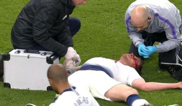 Tottenham vs. Ajax: Vertonghen sangró por este golpe que lo dejó mareado y sacó del partido de Champions League. (Foto: Reuters)