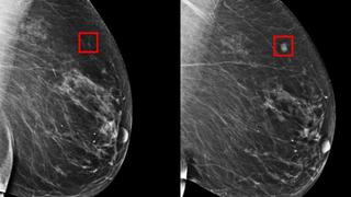 Inteligencia artificial sería capaz de detectar el cáncer de mama 4 años antes de formarse