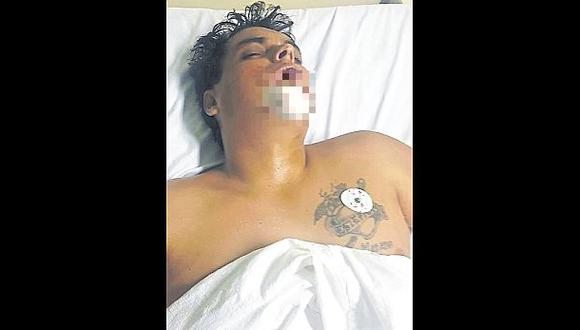 Giancarlo Zegarra Cuadros, 'Careca', recibió un disparo en la quijada al tratar de asaltar a una pareja en Miraflores. (USI)