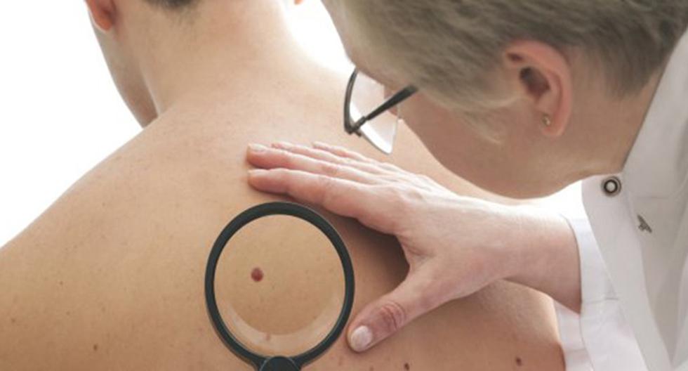 Despistajes gratuitos de cáncer de piel serán realizados en reconocido centro comercial. (Foto: ThinkStock)