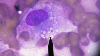 Hallan mecanismo celular que propicia la metástasis del cáncer