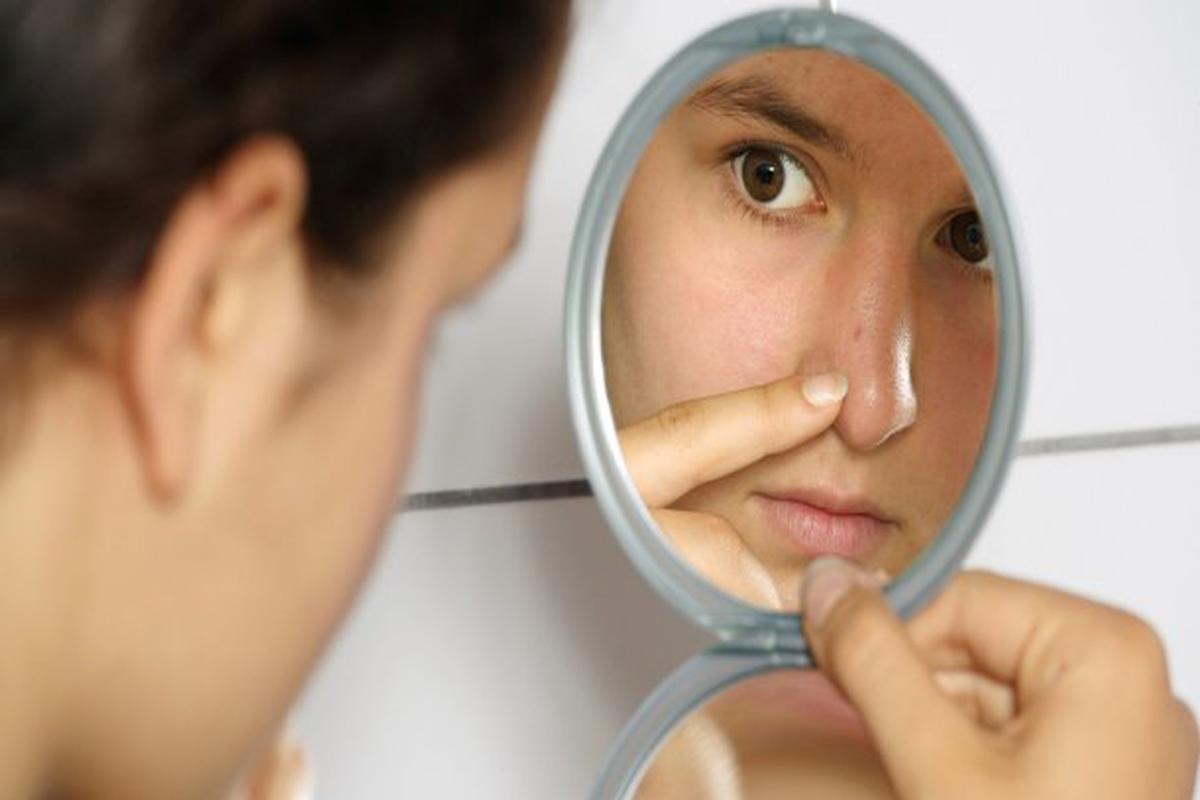 5 recetas caseras para combatir el acné | ESTILO-DE-VIDA 