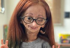 Fallece Adalia Rose, la youtuber que inspiró la película “El curioso caso de Benjamin Button”