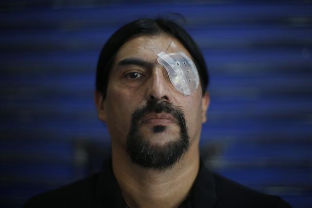 Nelson Iturriaga perdió un ojo después de que la policía le disparara con una escopeta durante las manifestaciones antigubernamentales frente al Palacio de La Moneda, en Santiago de Chile. (Foto AP / Luis Hidalgo).