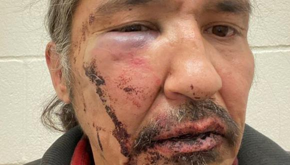 Allan Adam mostrando las heridas que asegura que le causaron agentes de la policía canadiense. (Foto: Reuters).
